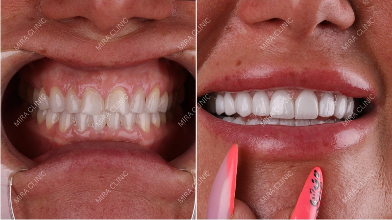 Before and After